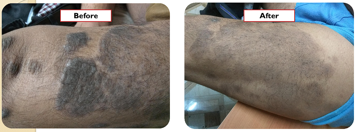 Case 4: Chronic Plaque Psoriasis - 42 years